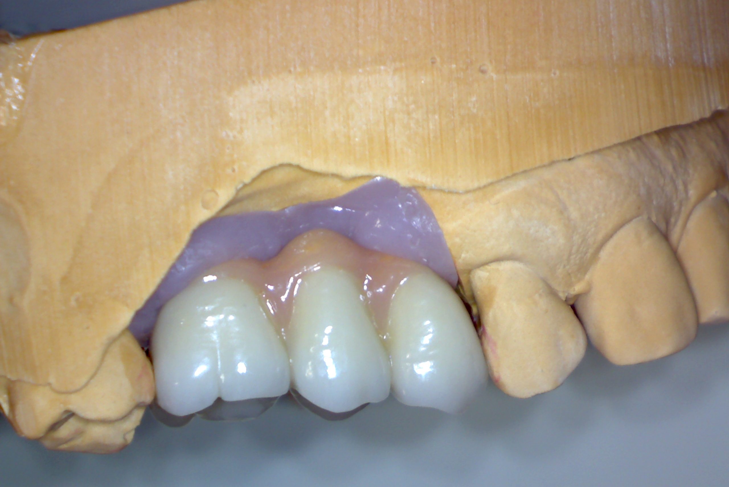cropped-Pont-Sur-Implant-Hybride-2.jpg